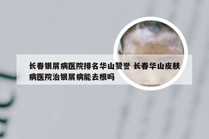 长春银屑病医院排名华山赞誉 长春华山皮肤病医院治银屑病能去根吗