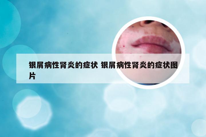 银屑病性肾炎的症状 银屑病性肾炎的症状图片