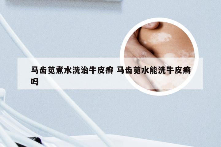 马齿苋煮水洗治牛皮癣 马齿苋水能洗牛皮癣吗
