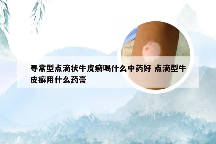 寻常型点滴状牛皮癣喝什么中药好 点滴型牛皮癣用什么药膏