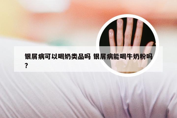 银屑病可以喝奶类品吗 银屑病能喝牛奶粉吗?