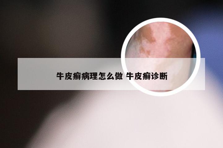 牛皮癣病理怎么做 牛皮癣诊断