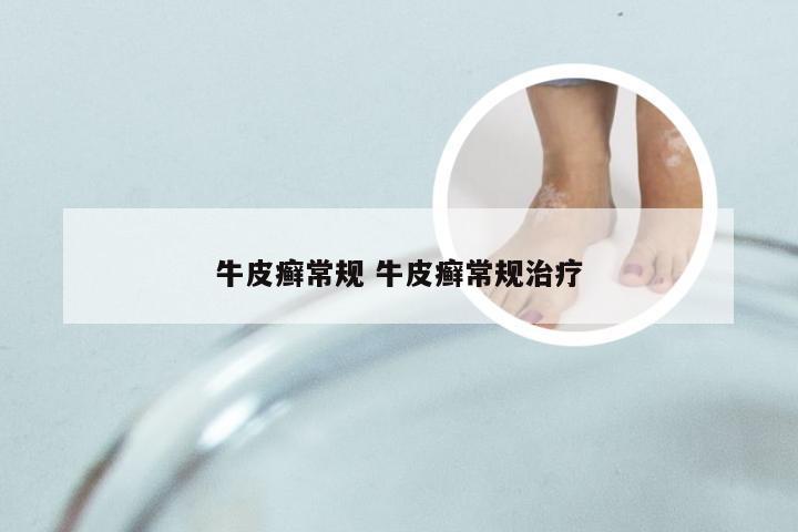 牛皮癣常规 牛皮癣常规治疗