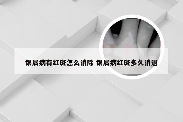 银屑病有红斑怎么消除 银屑病红斑多久消退