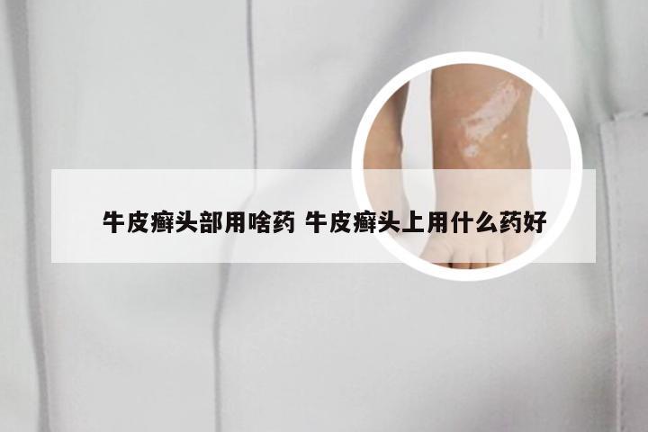 牛皮癣头部用啥药 牛皮癣头上用什么药好