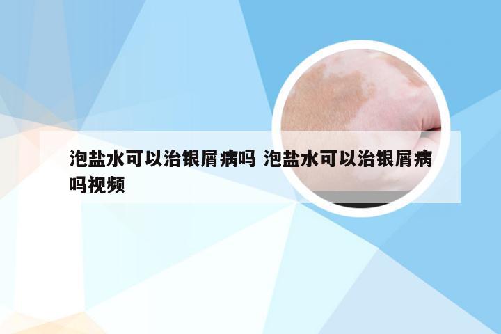 泡盐水可以治银屑病吗 泡盐水可以治银屑病吗视频