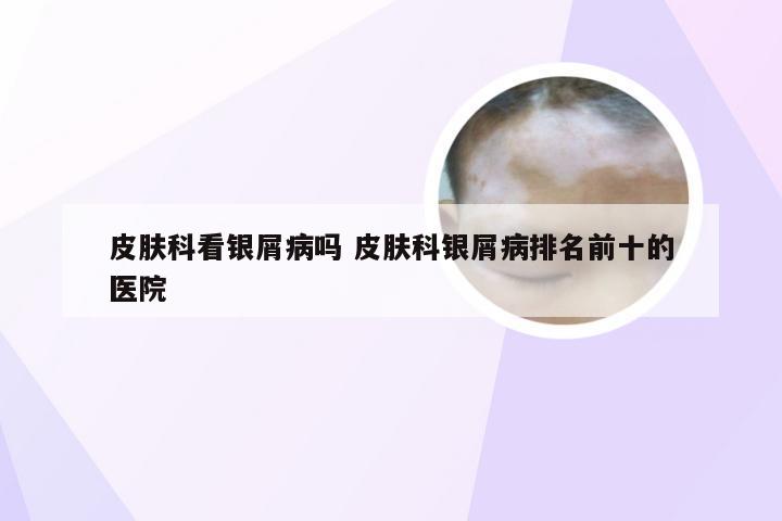 皮肤科看银屑病吗 皮肤科银屑病排名前十的医院