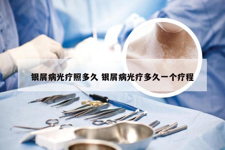 银屑病光疗照多久 银屑病光疗多久一个疗程