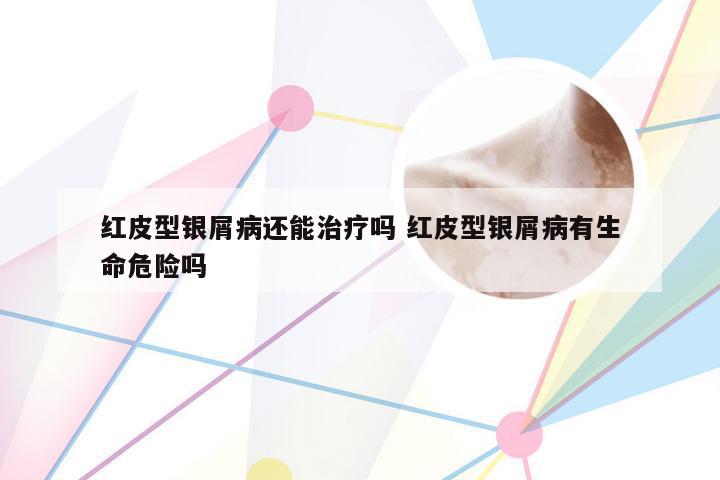 红皮型银屑病还能治疗吗 红皮型银屑病有生命危险吗