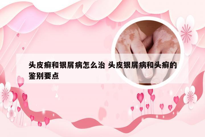 头皮癣和银屑病怎么治 头皮银屑病和头癣的鉴别要点