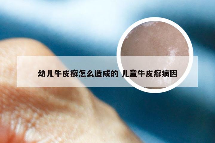 幼儿牛皮癣怎么造成的 儿童牛皮癣病因