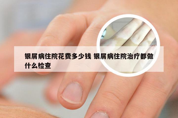 银屑病住院花费多少钱 银屑病住院治疗都做什么检查
