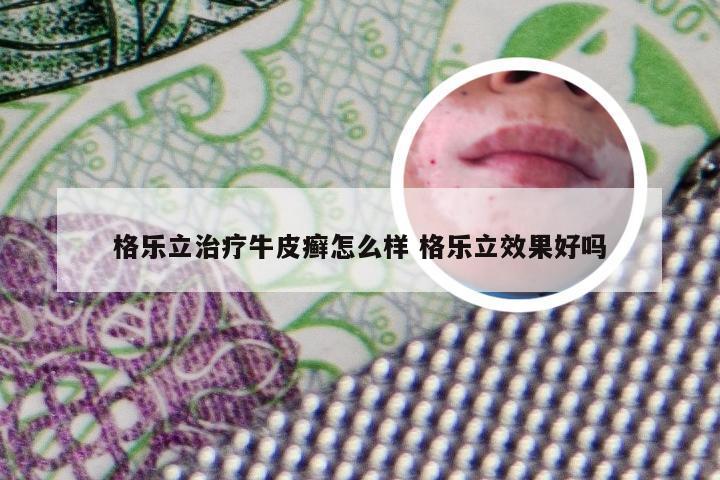 格乐立治疗牛皮癣怎么样 格乐立效果好吗