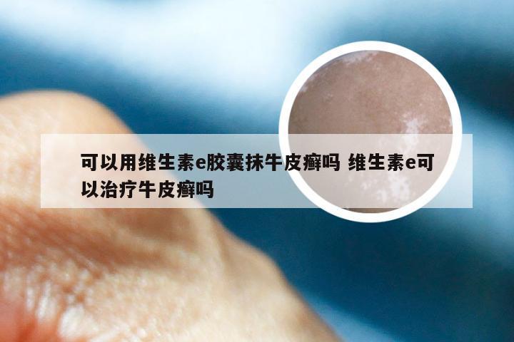 可以用维生素e胶囊抹牛皮癣吗 维生素e可以治疗牛皮癣吗