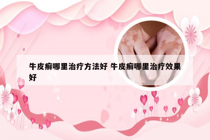 牛皮癣哪里治疗方法好 牛皮癣哪里治疗效果好
