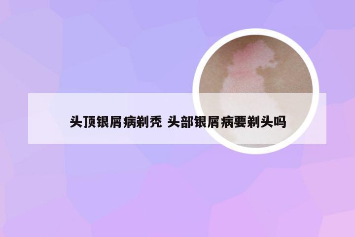 头顶银屑病剃秃 头部银屑病要剃头吗