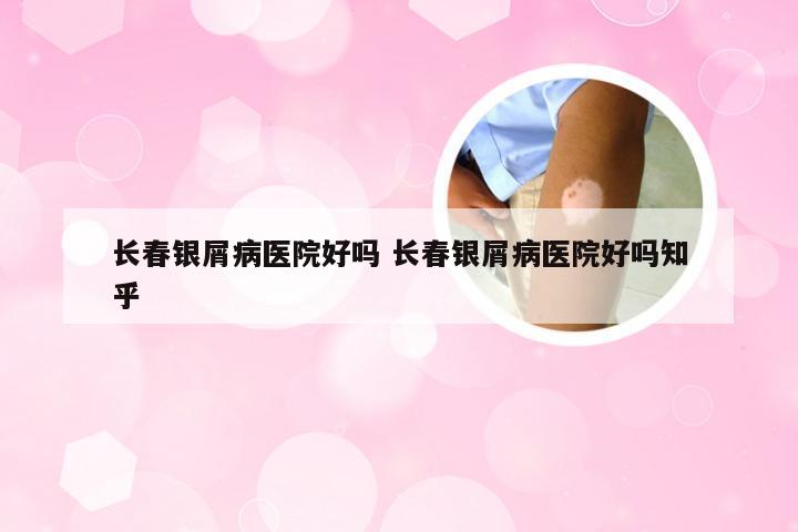 长春银屑病医院好吗 长春银屑病医院好吗知乎