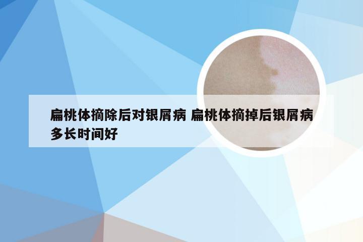 扁桃体摘除后对银屑病 扁桃体摘掉后银屑病多长时间好