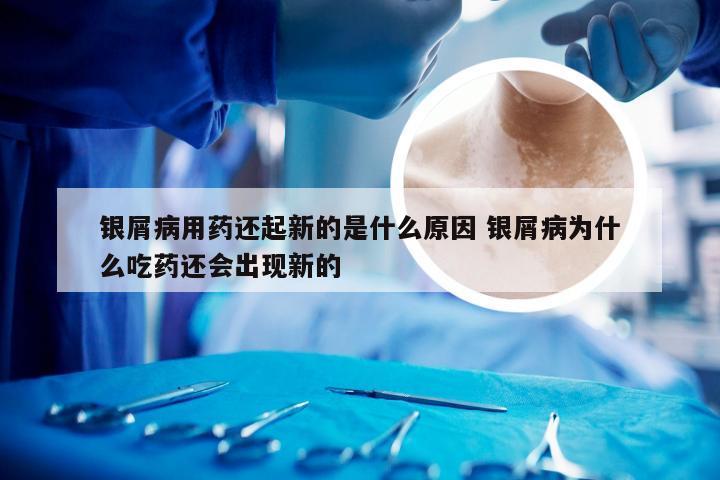银屑病用药还起新的是什么原因 银屑病为什么吃药还会出现新的