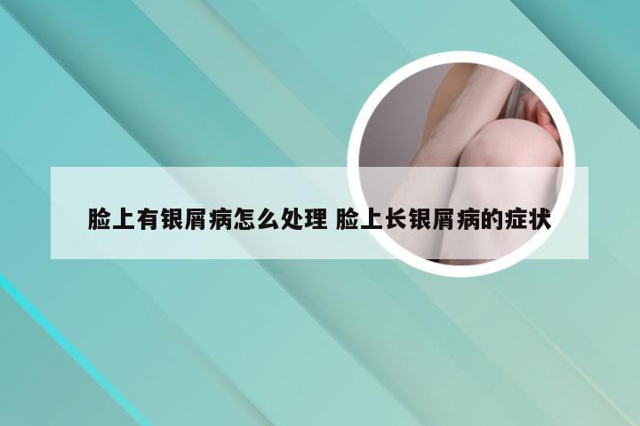 脸上有银屑病怎么处理 脸上长银屑病的症状