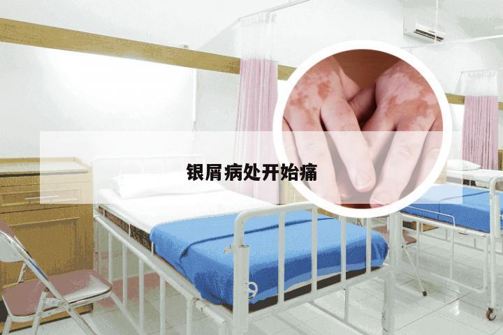 银屑病处开始痛
