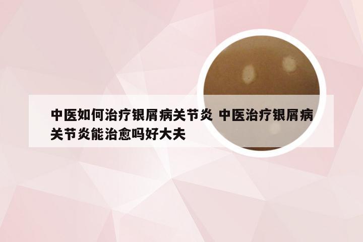 中医如何治疗银屑病关节炎 中医治疗银屑病关节炎能治愈吗好大夫
