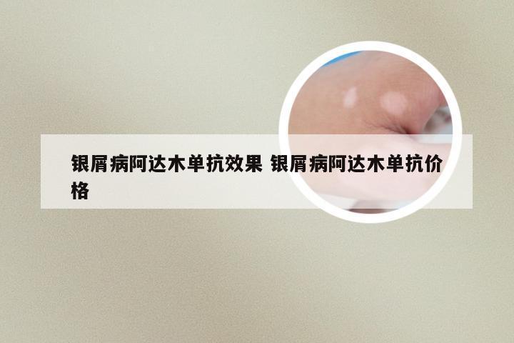 银屑病阿达木单抗效果 银屑病阿达木单抗价格