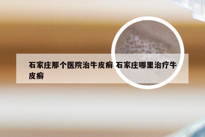 石家庄那个医院治牛皮癣 石家庄哪里治疗牛皮癣