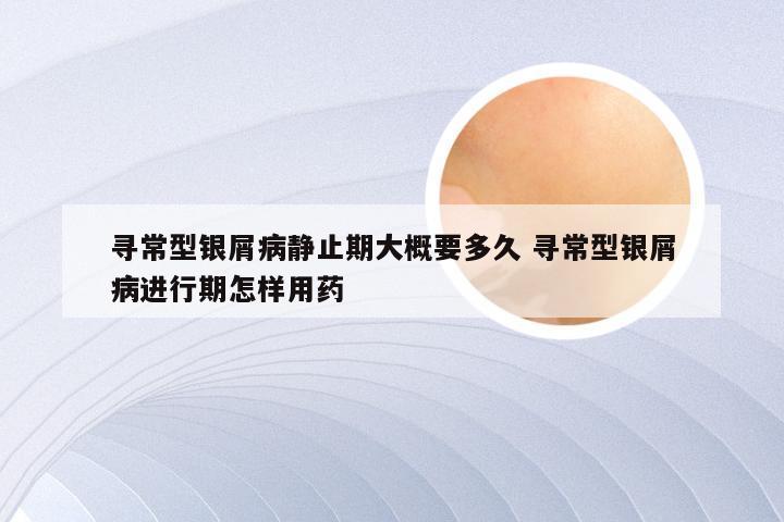 寻常型银屑病静止期大概要多久 寻常型银屑病进行期怎样用药