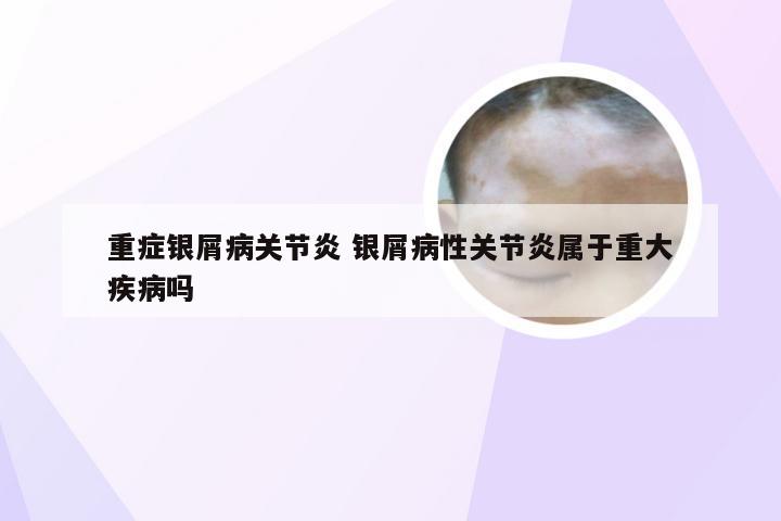 重症银屑病关节炎 银屑病性关节炎属于重大疾病吗