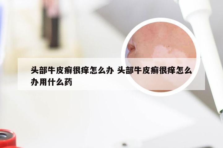头部牛皮癣很痒怎么办 头部牛皮癣很痒怎么办用什么药