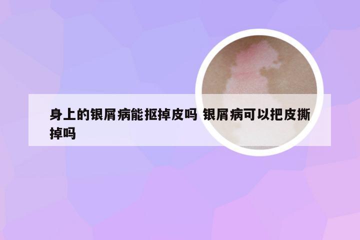 身上的银屑病能抠掉皮吗 银屑病可以把皮撕掉吗