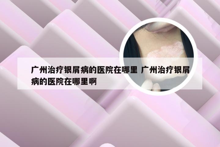 广州治疗银屑病的医院在哪里 广州治疗银屑病的医院在哪里啊