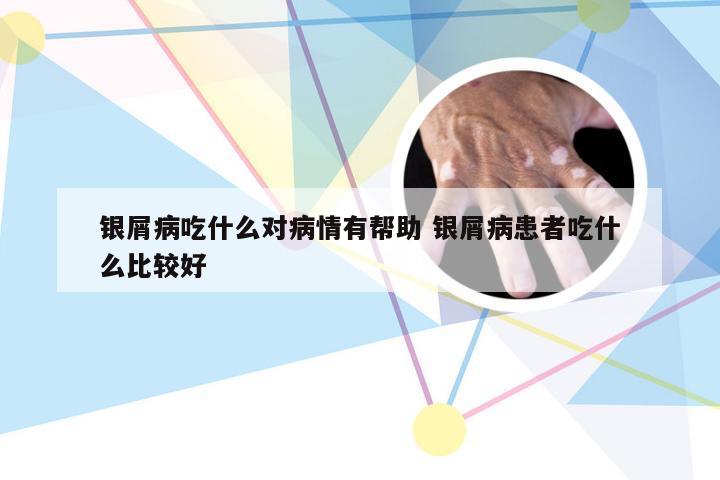 银屑病吃什么对病情有帮助 银屑病患者吃什么比较好