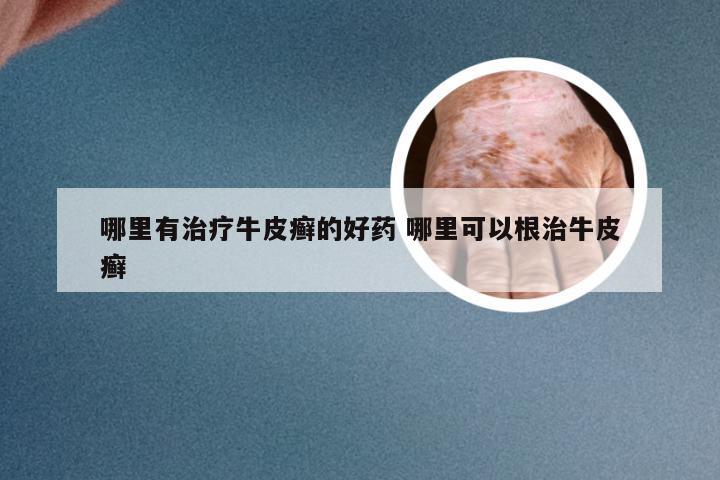 哪里有治疗牛皮癣的好药 哪里可以根治牛皮癣