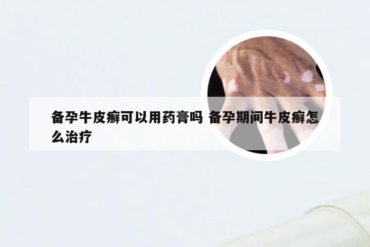 备孕牛皮癣可以用药膏吗 备孕期间牛皮癣怎么治疗