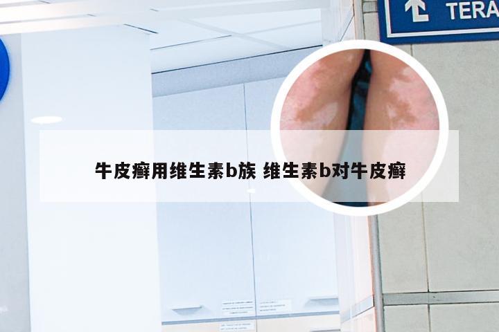 牛皮癣用维生素b族 维生素b对牛皮癣