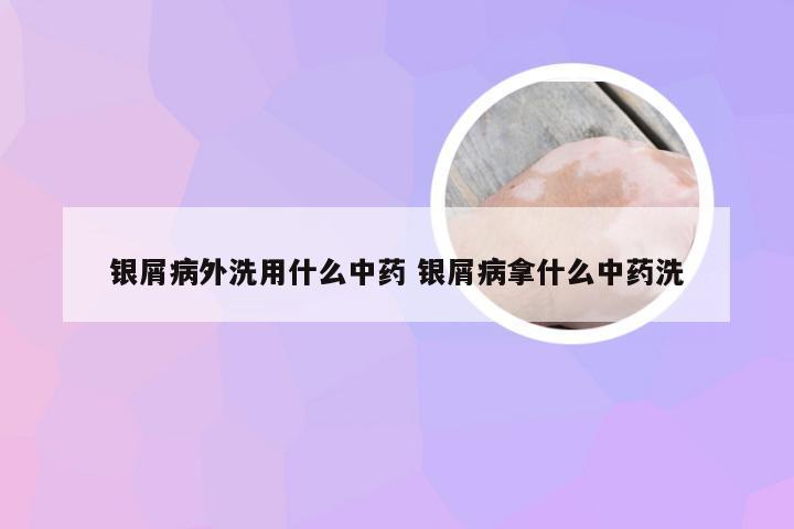 银屑病外洗用什么中药 银屑病拿什么中药洗