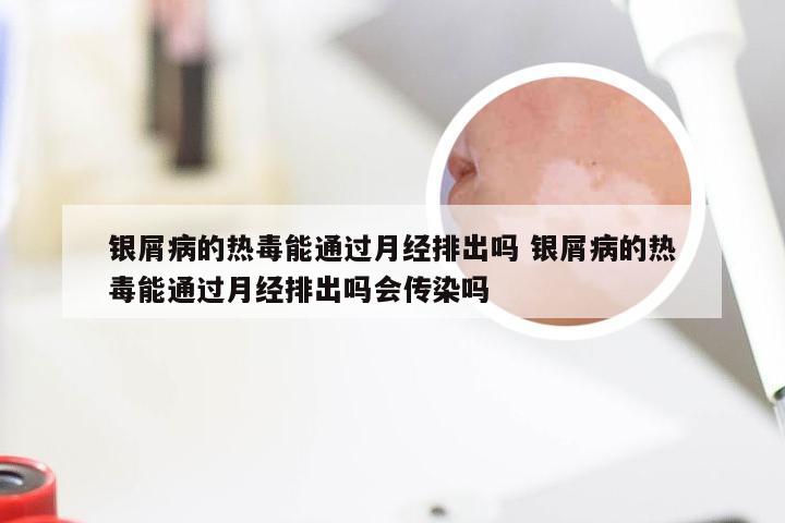 银屑病的热毒能通过月经排出吗 银屑病的热毒能通过月经排出吗会传染吗