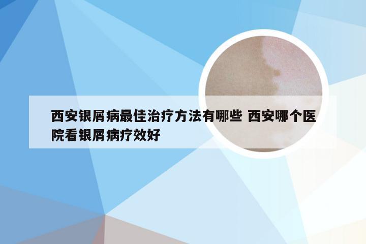西安银屑病最佳治疗方法有哪些 西安哪个医院看银屑病疗效好