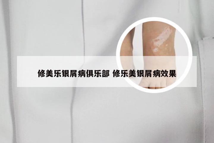 修美乐银屑病俱乐部 修乐美银屑病效果