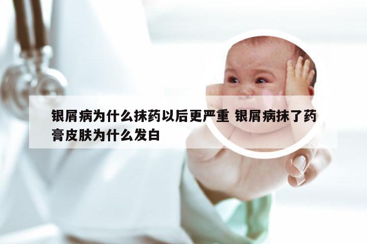 银屑病为什么抹药以后更严重 银屑病抹了药膏皮肤为什么发白