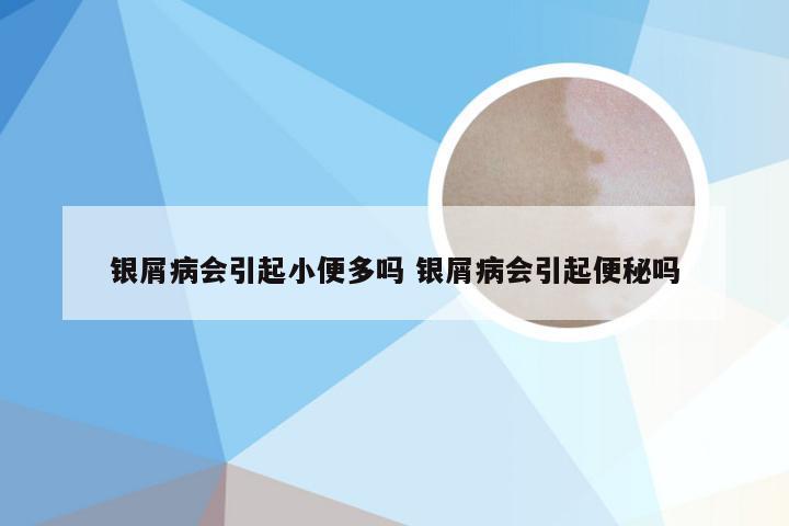 银屑病会引起小便多吗 银屑病会引起便秘吗