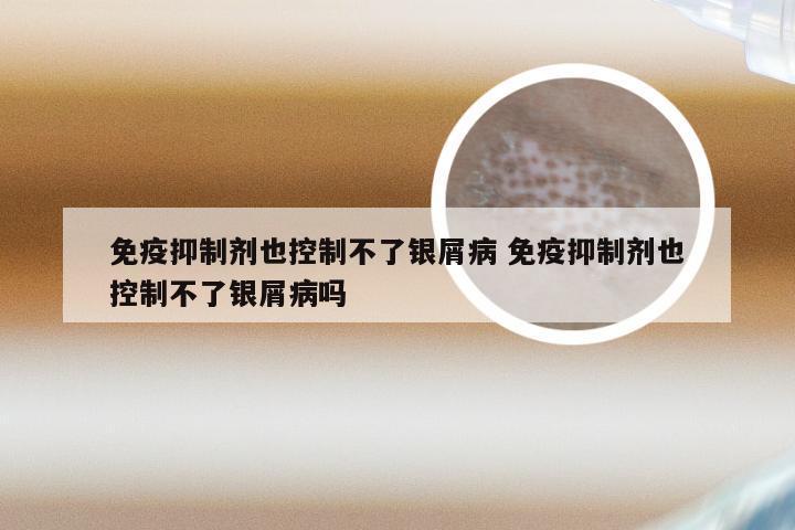 免疫抑制剂也控制不了银屑病 免疫抑制剂也控制不了银屑病吗