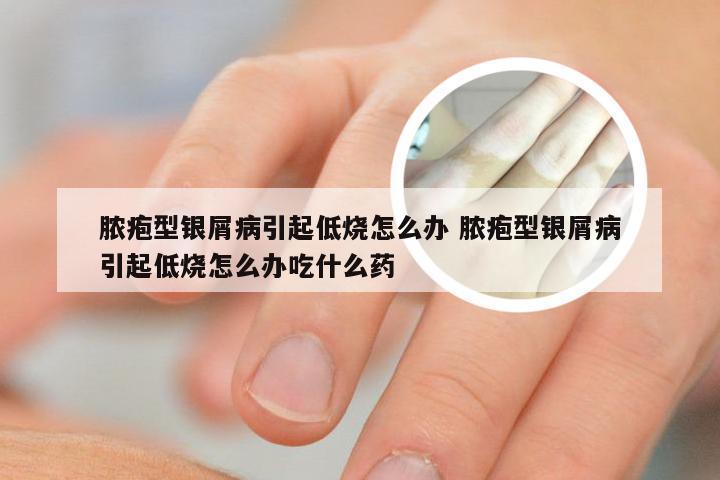 脓疱型银屑病引起低烧怎么办 脓疱型银屑病引起低烧怎么办吃什么药