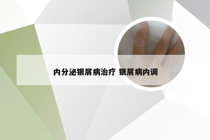内分泌银屑病治疗 银屑病内调