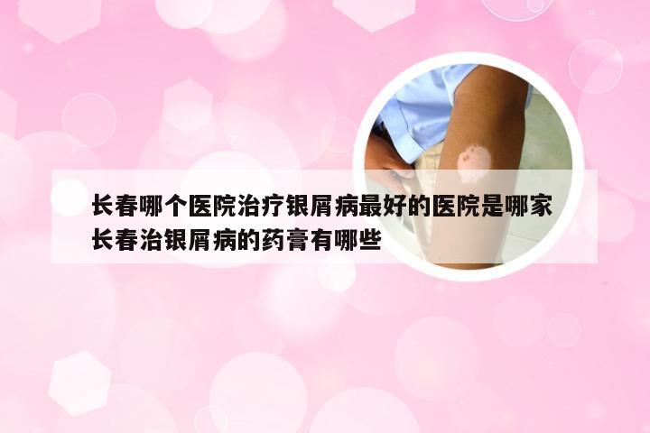 长春哪个医院治疗银屑病最好的医院是哪家 长春治银屑病的药膏有哪些