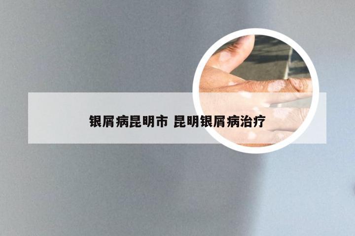 银屑病昆明市 昆明银屑病治疗
