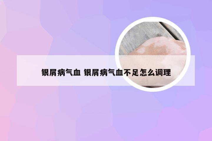 银屑病气血 银屑病气血不足怎么调理