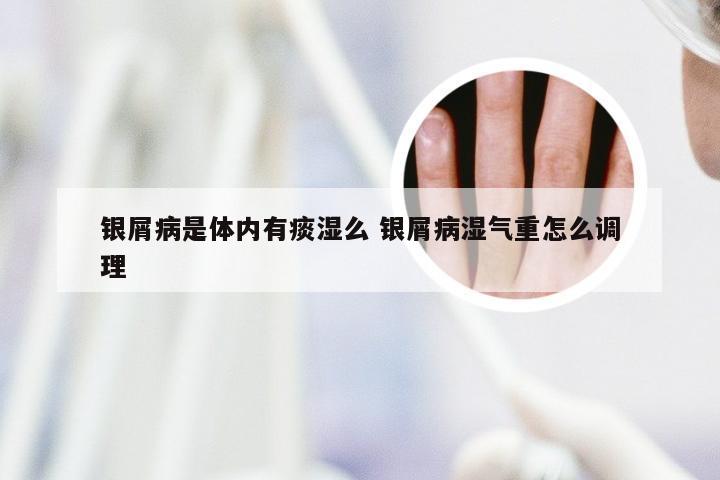 银屑病是体内有痰湿么 银屑病湿气重怎么调理